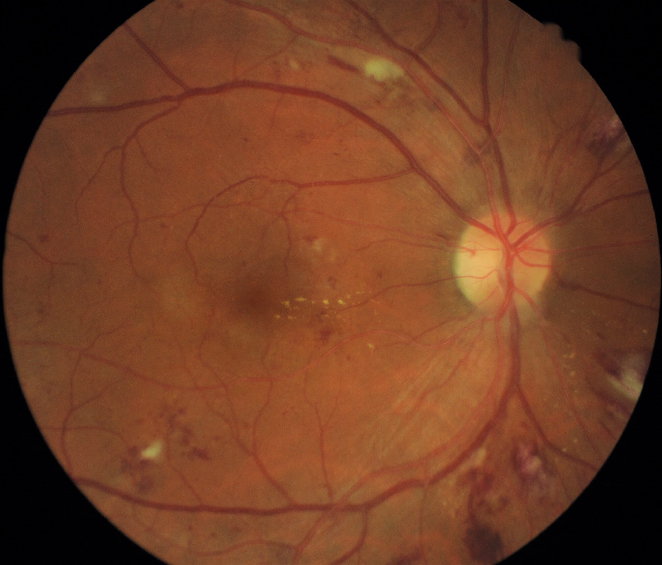 retina retinopatii